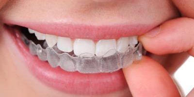 Aligner-Invisalign