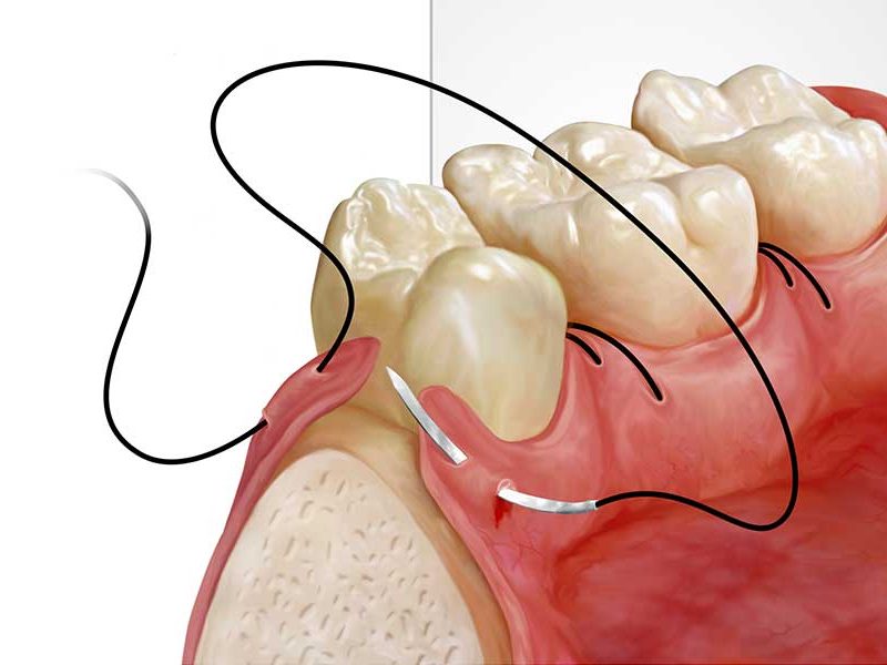 Alveoloplasty-Houston
