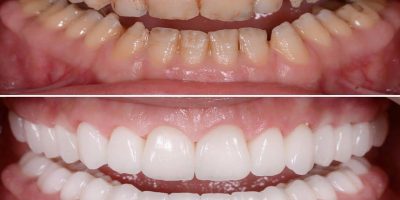 Full-Mouth-Rehablitation