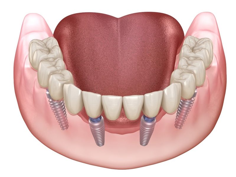 Full mouth Rehabilitation