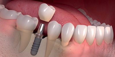 Immediate-Loaded-Dental-Implants-thumb-2