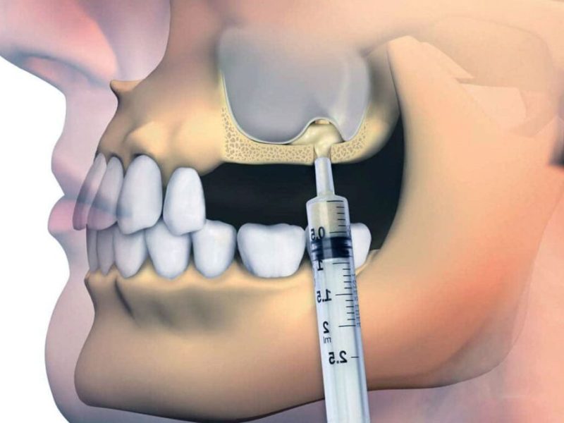 Sinüs-Lifting-1024x683