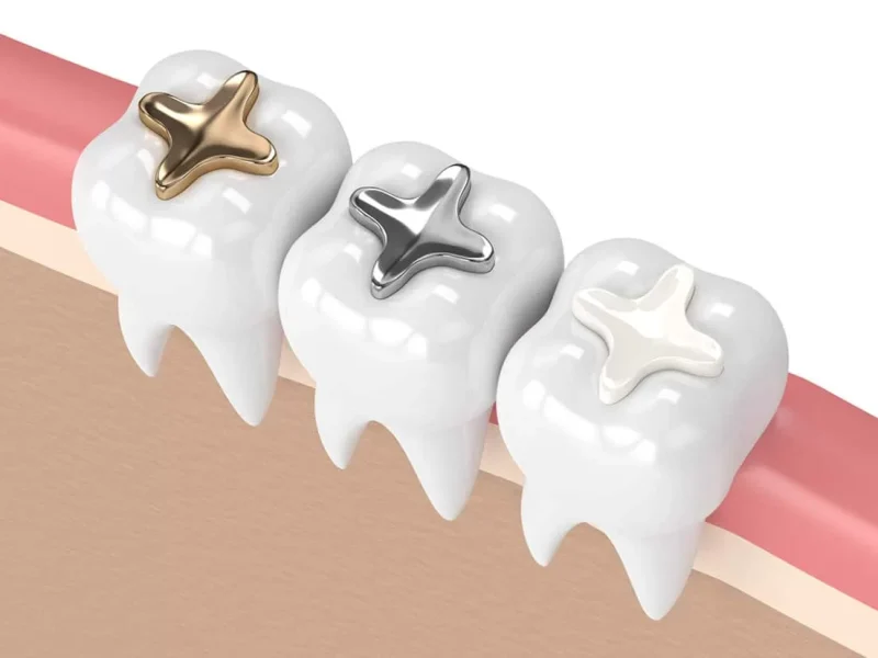 direct-dental-fillings