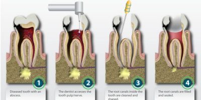 single-sitting-root-canal-treatment