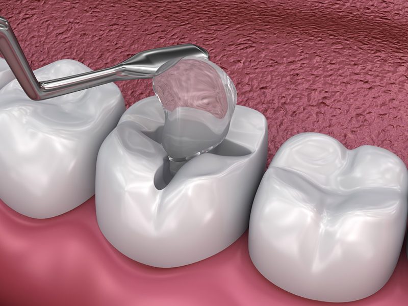 temporary-tooth-filling