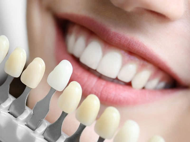 tooth-coloured-fillings